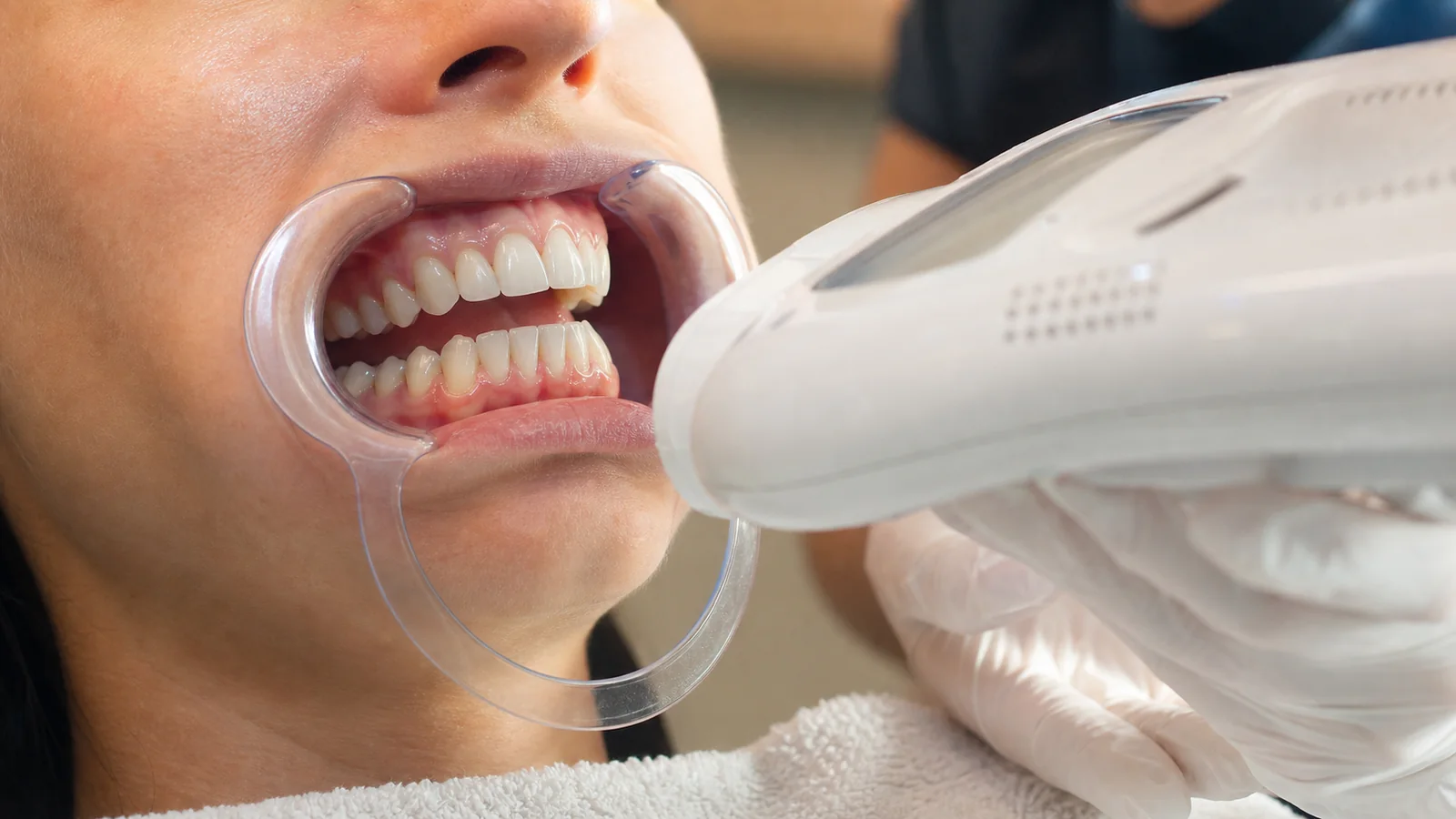 Blanchiment dentaire esthétique en institut près de Poitiers Gros plan des dents pendant un blanchiment dentaire esthétique en institut près de Poitiers